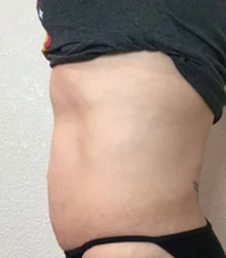 CryoSkin client after, stomach