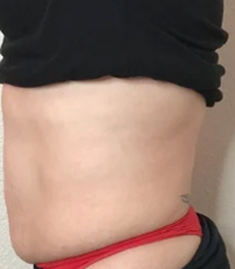 CryoSkin client before, stomach