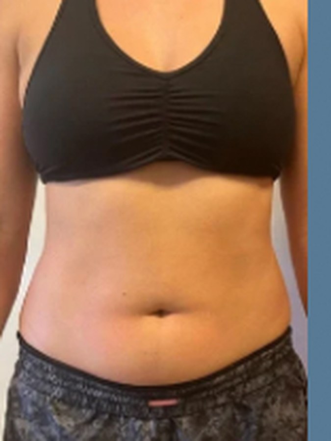 CryoSkin client after, stomach