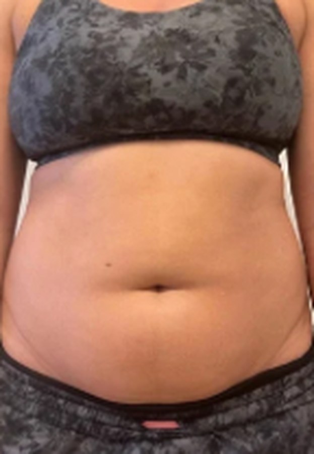 CryoSkin client before, stomach