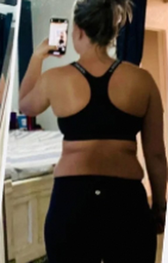 CryoSkin client before, back