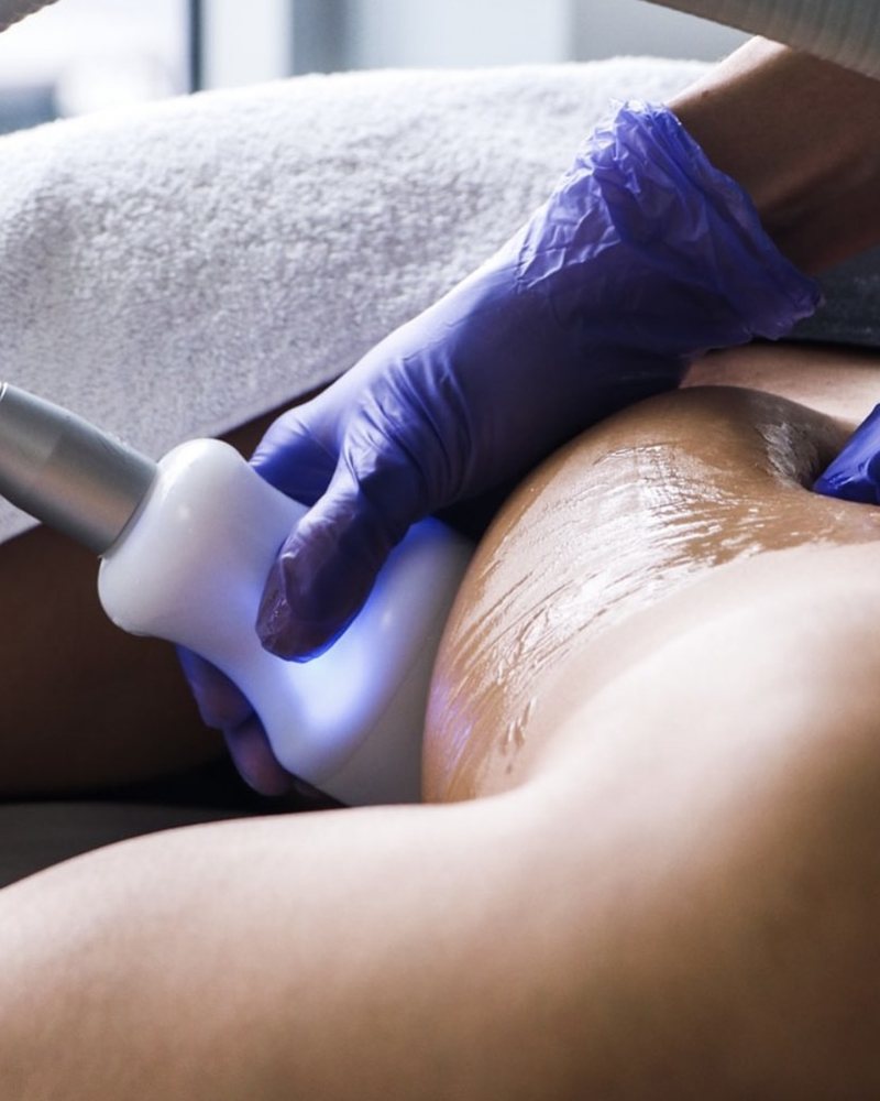 CryoSkin toning treatment